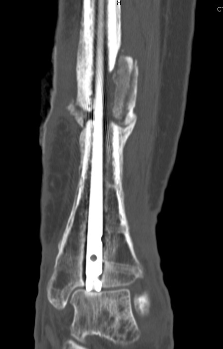 Infected Tibial Nonunion CT